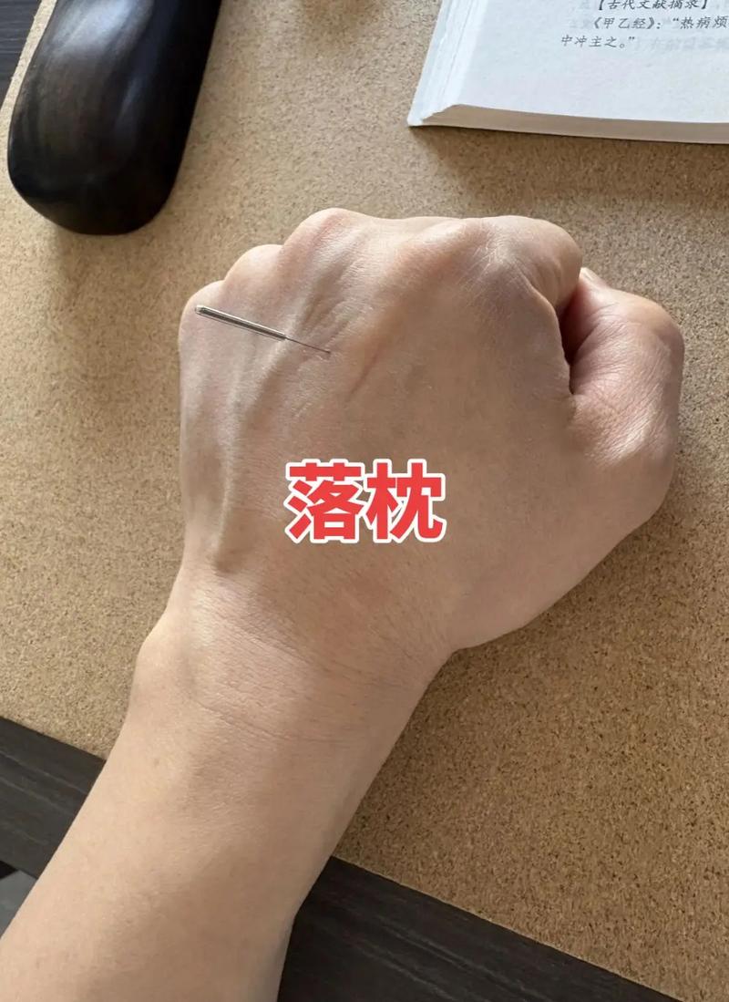 脖子落枕可以针灸吗