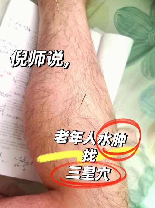 水肿针灸可以治好吗