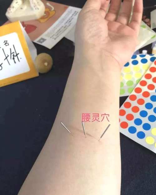 急性腰扭伤针灸哪里