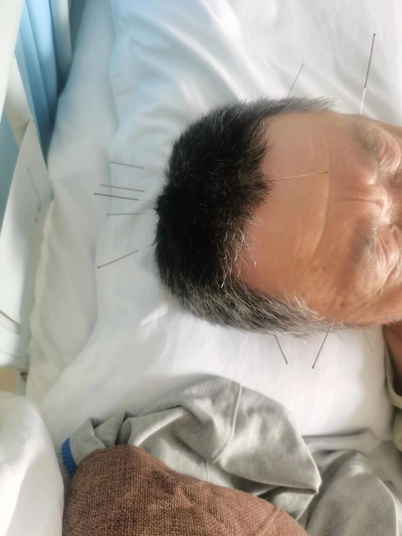 智力落后能用针灸吗