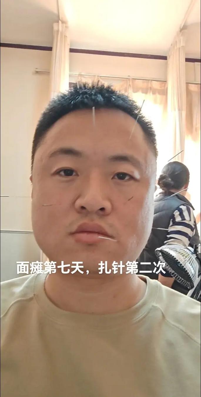 针灸治疗周围性面瘫