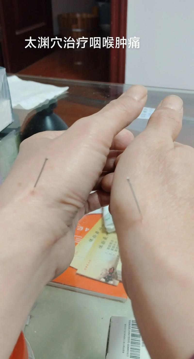 咽喉疼针灸手上哪里