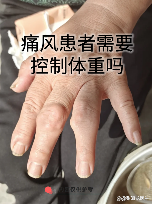 减肥期间为什么犯痛风