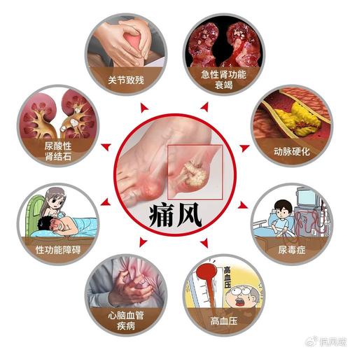 痛风可以做到永不复发