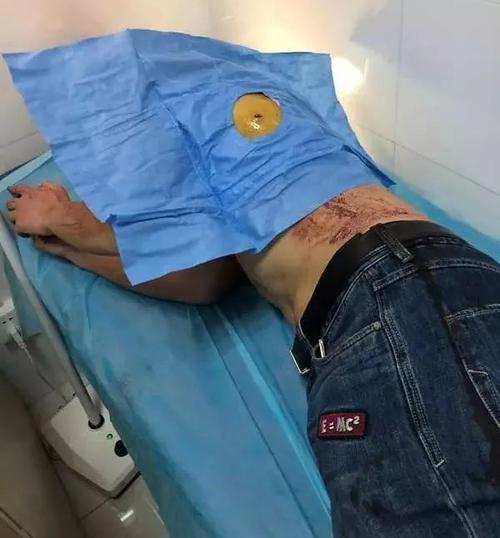 刀捅在腹部哪里最安全