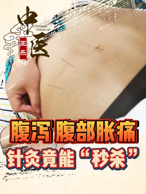 肠胃胀气可以针灸吗