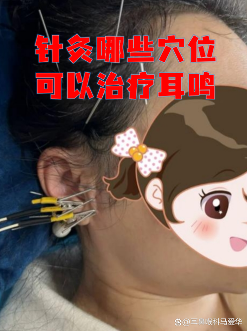 针灸听宫要注意什么