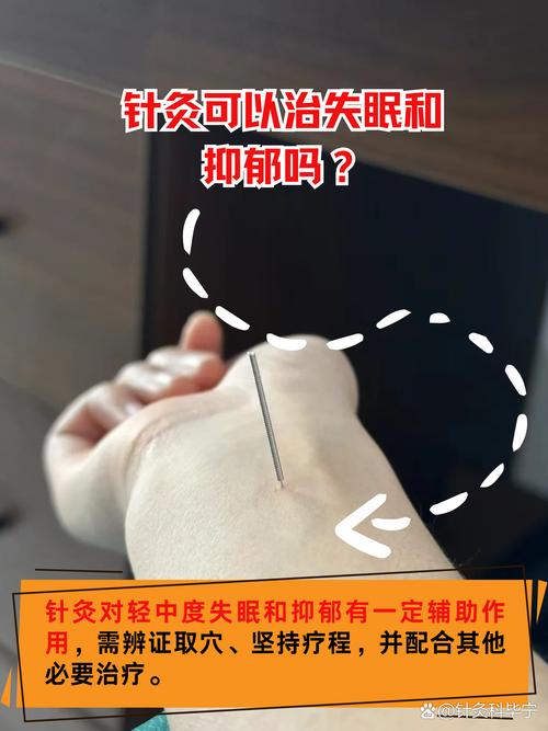 孕妇失眠用针灸调理