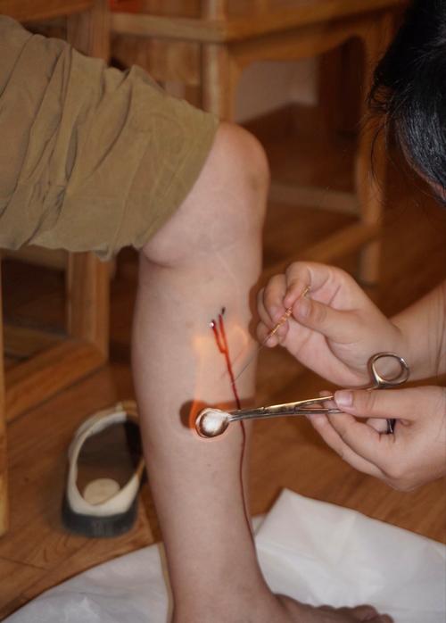 针灸可以治疗湿热吗