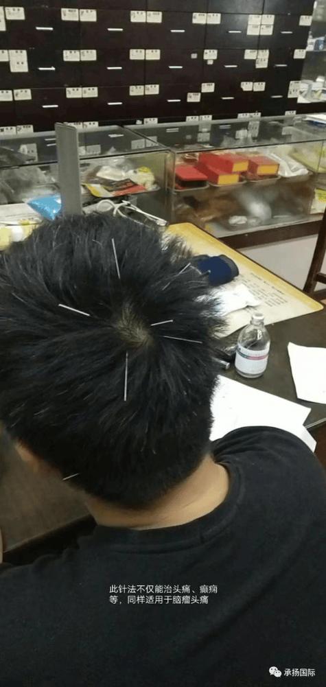 针灸治疗脑肿瘤瞎眼