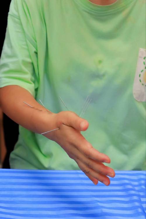 海口针灸培训哪家好