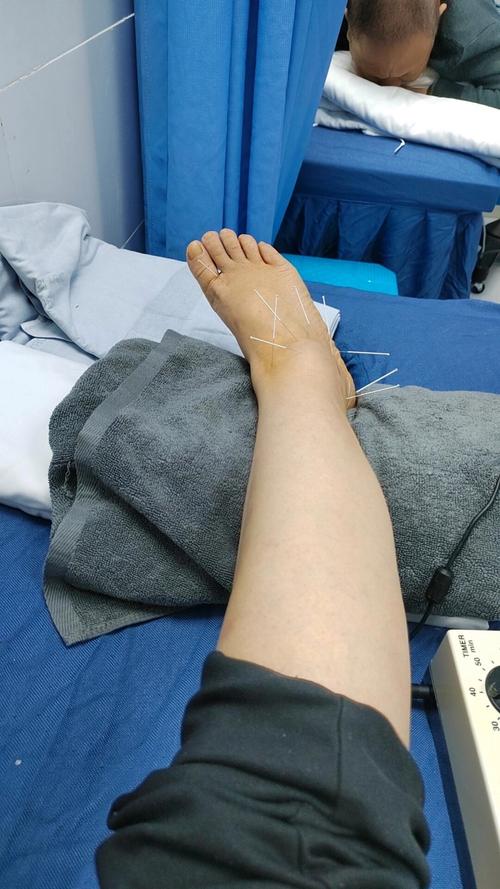 脚踝积液可以针灸吗