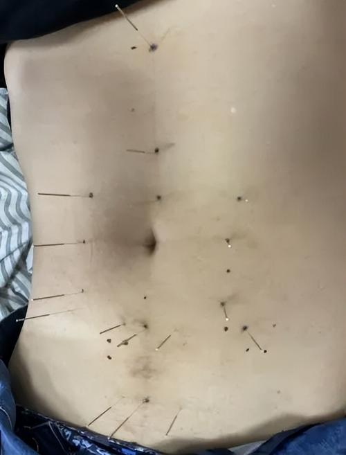 肚子胀气针灸管用吗