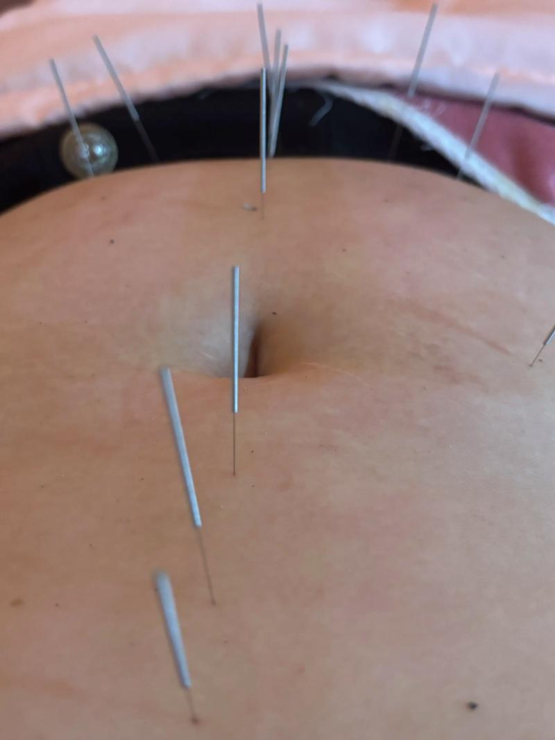 减肚子针灸哪个部位