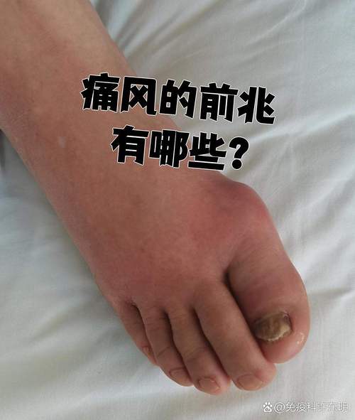 痛风的首发症状是什么