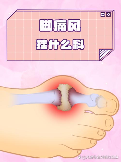 治疗痛风应该挂什么科