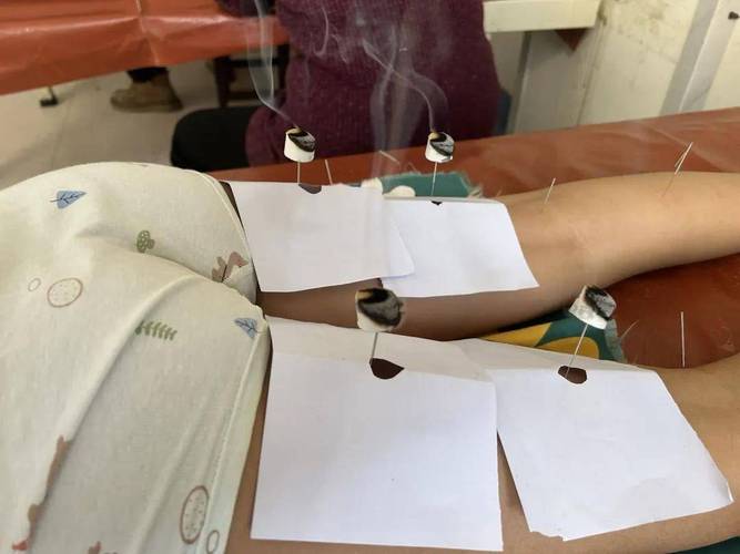 针灸可以治疗脑瘫吗