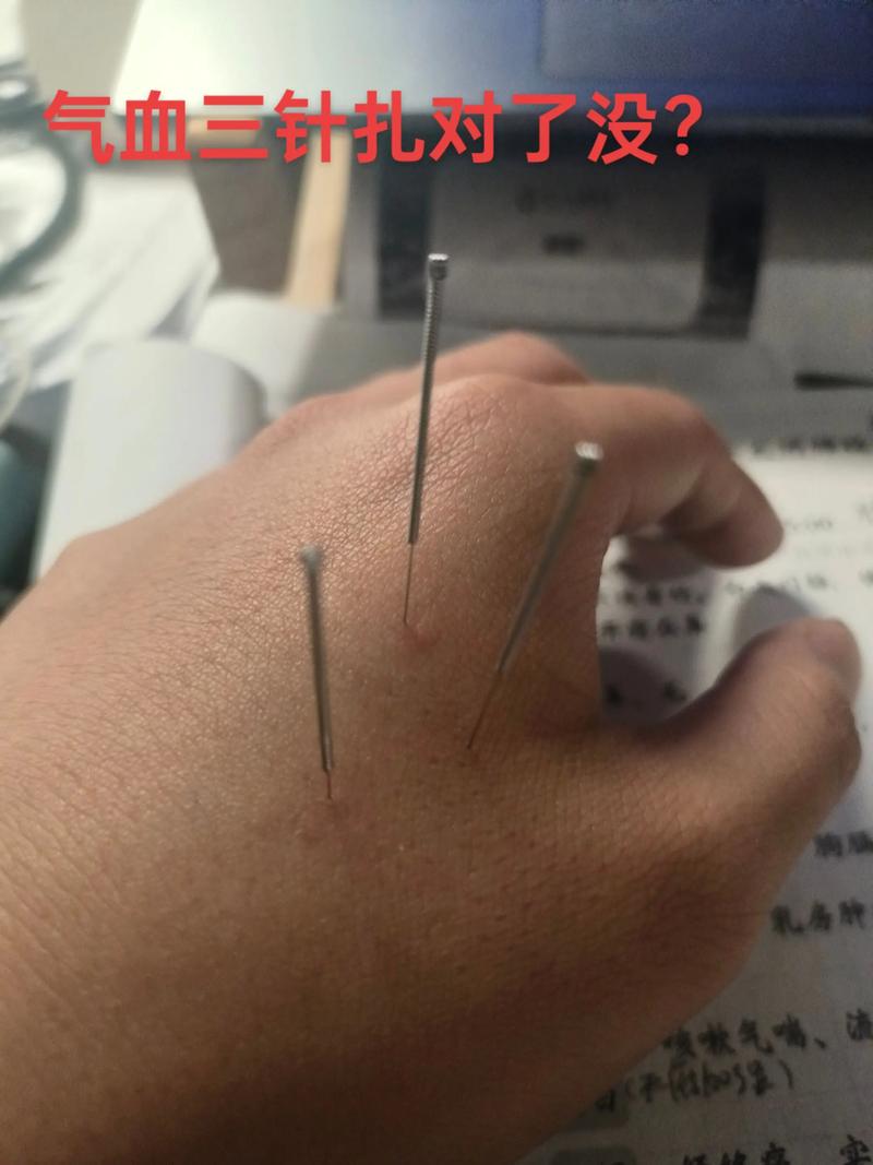 下鼻甲肥大针灸放血