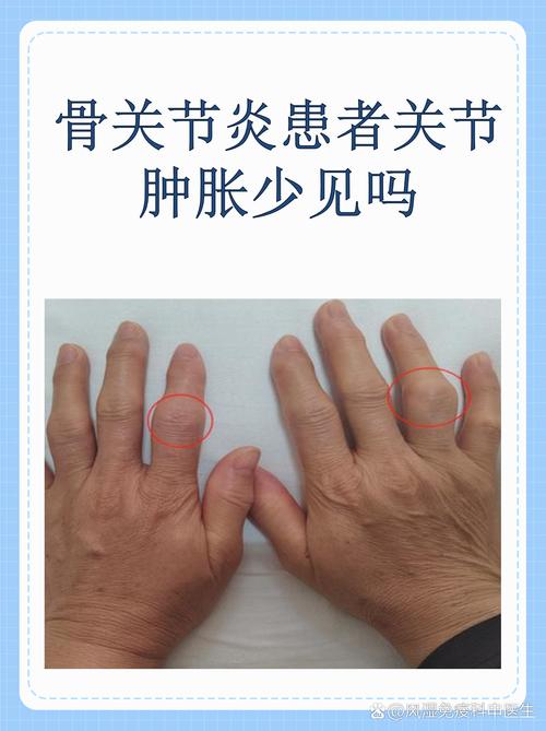 痛风关节肿大能恢复么