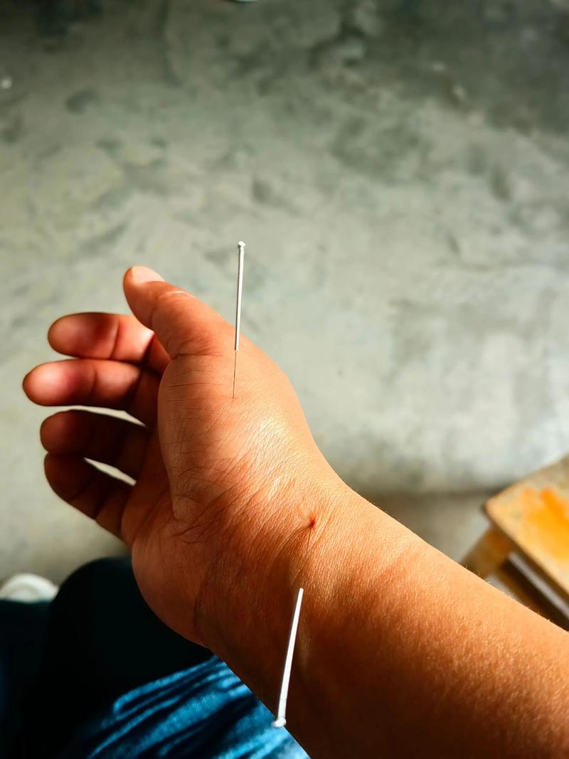 鞍山哪有祖传扎针灸