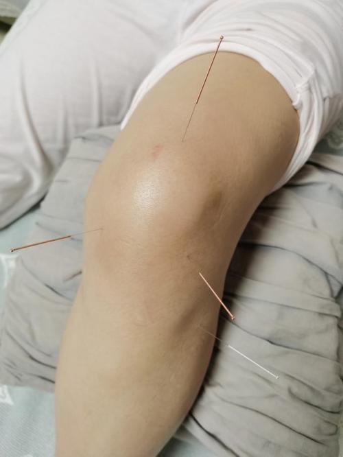膝盖受寒可以针灸吗