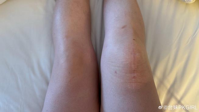 痛风膝盖一直肿不消肿