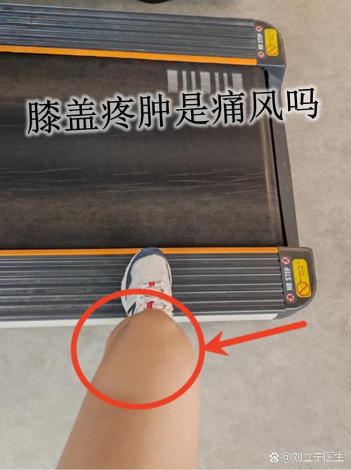 痛风膝盖一直肿不消肿