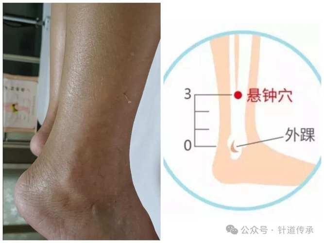 高血压针灸那个部位