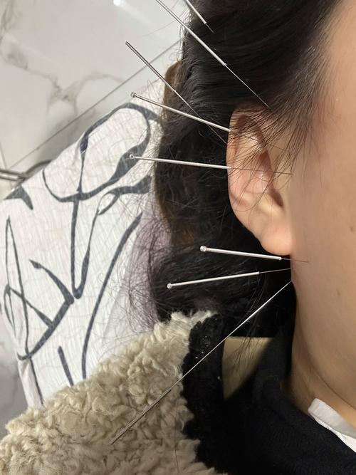 针灸治疗耳鸣的穴位