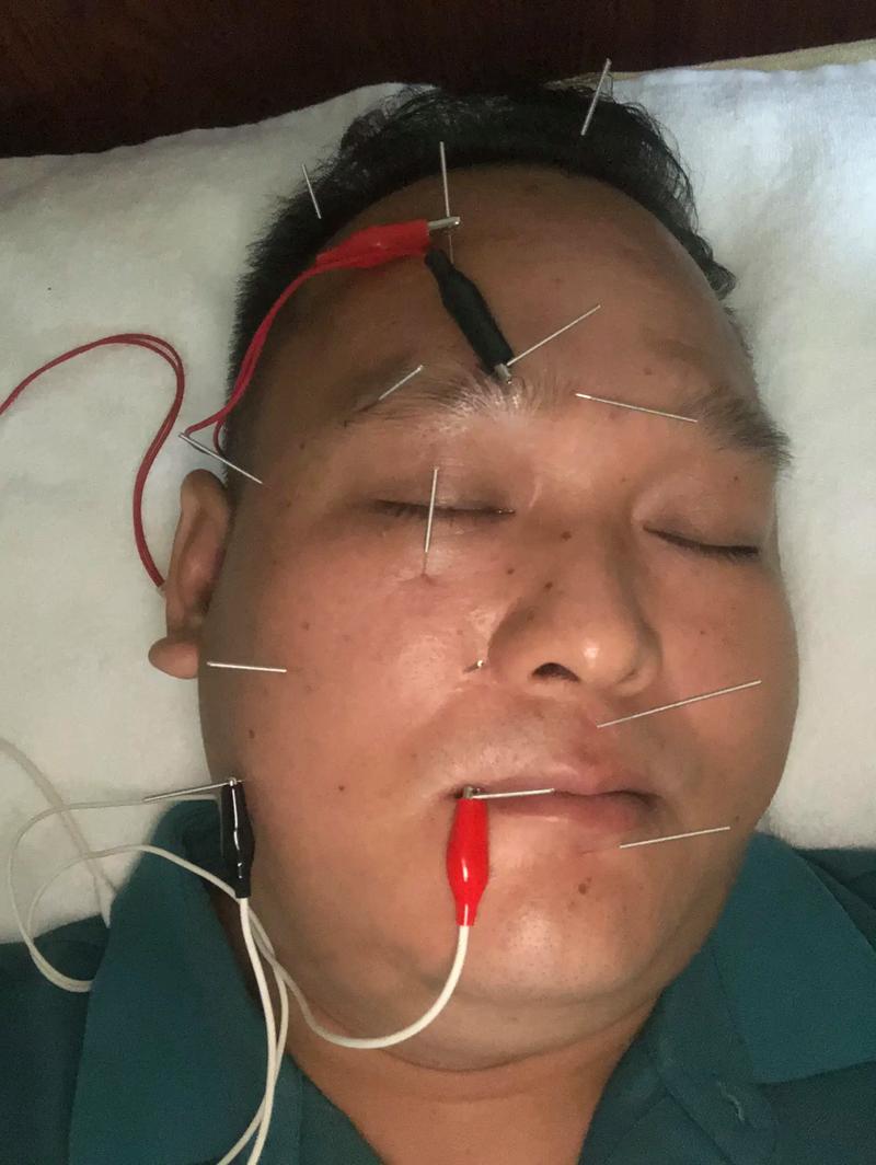 右脸神经面瘫 针灸