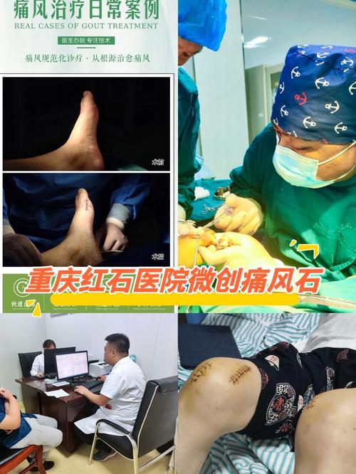 广州治疗痛风医院排名