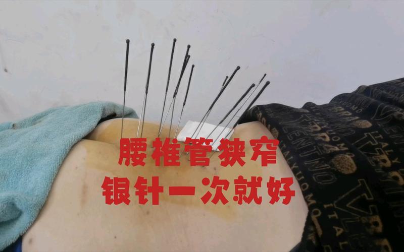 椎管狭窄可以针灸吗