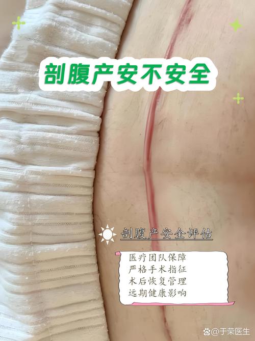 乡镇医院剖腹产安全吗