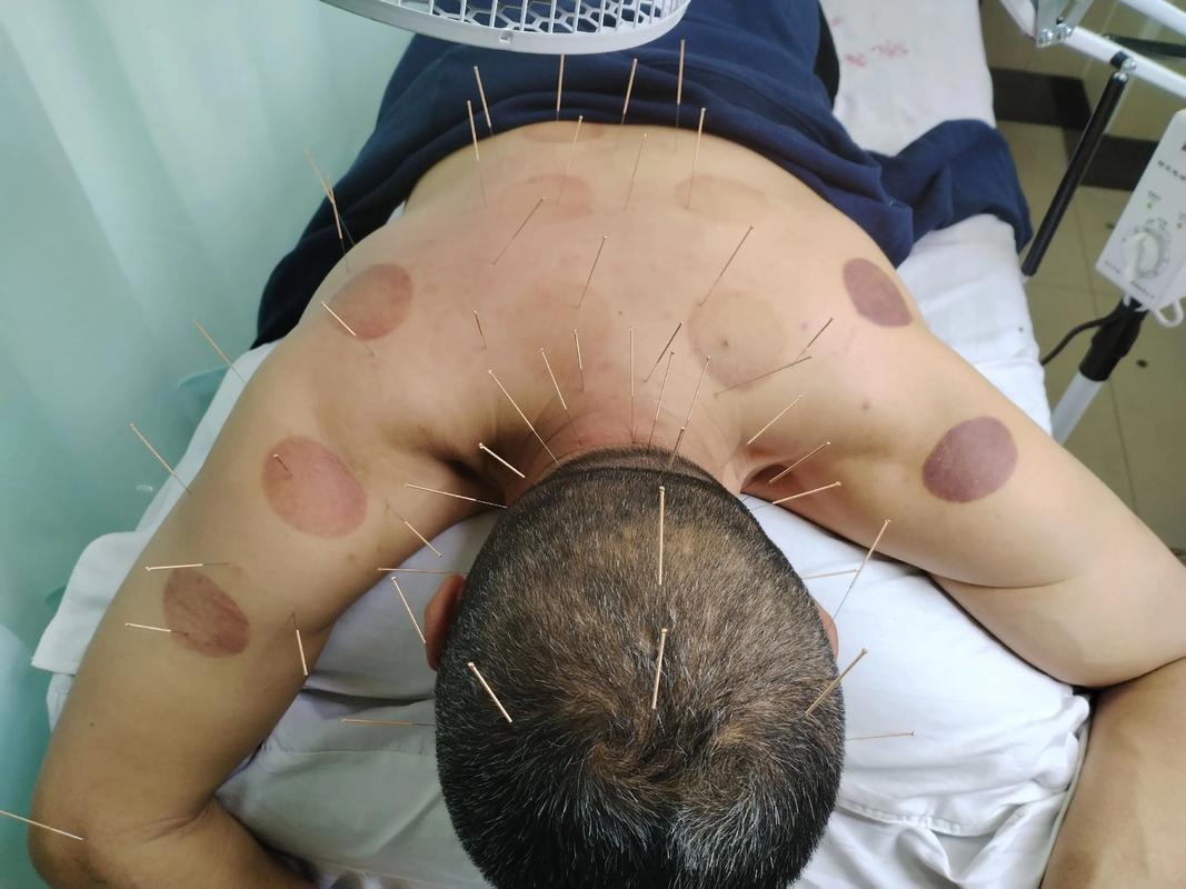 针灸减肥后头晕恶心