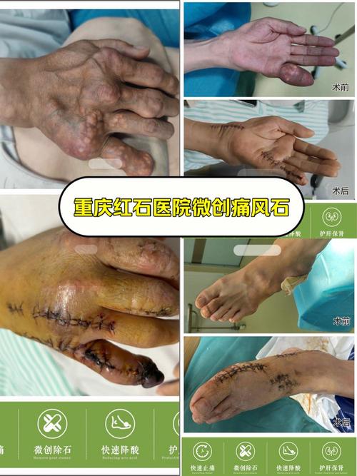 痛风做手术一般多少钱