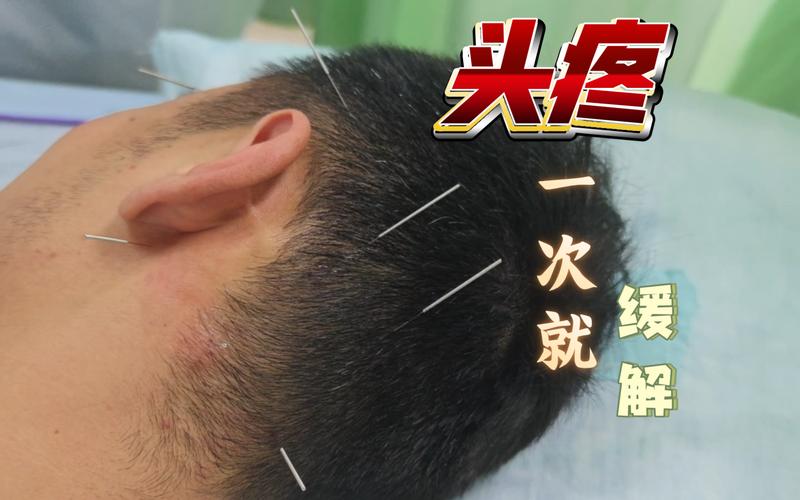 慢性紧张性头痛针灸