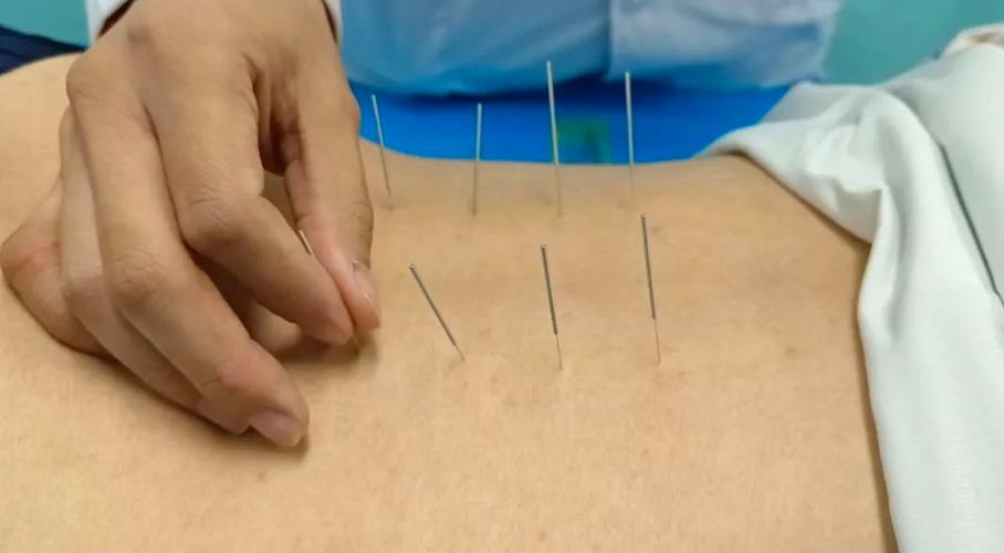 腰椎增生可以针灸吗