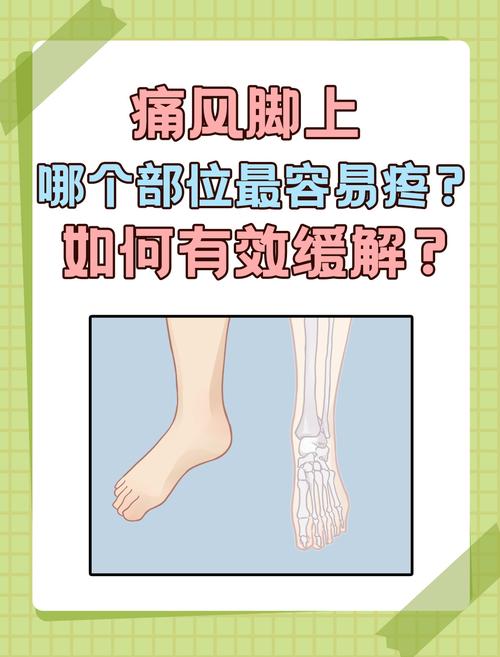 痛风为什么左右脚轮流