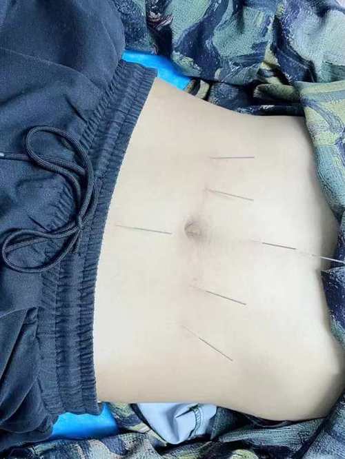 胃胀气针灸快速排气