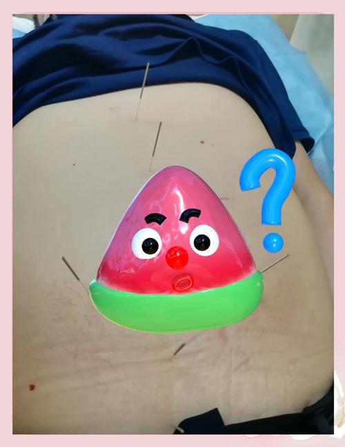 胃胀气针灸快速排气