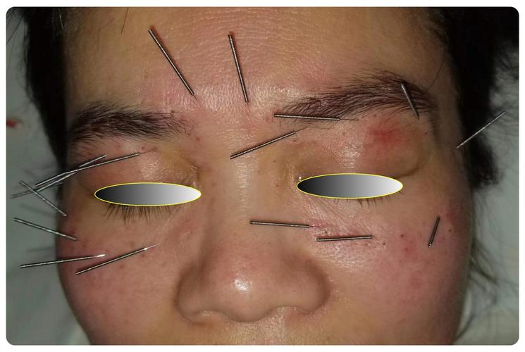 视网膜动脉阻塞针灸