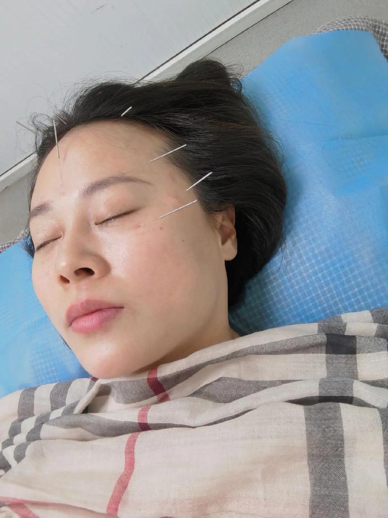 视网膜动脉阻塞针灸