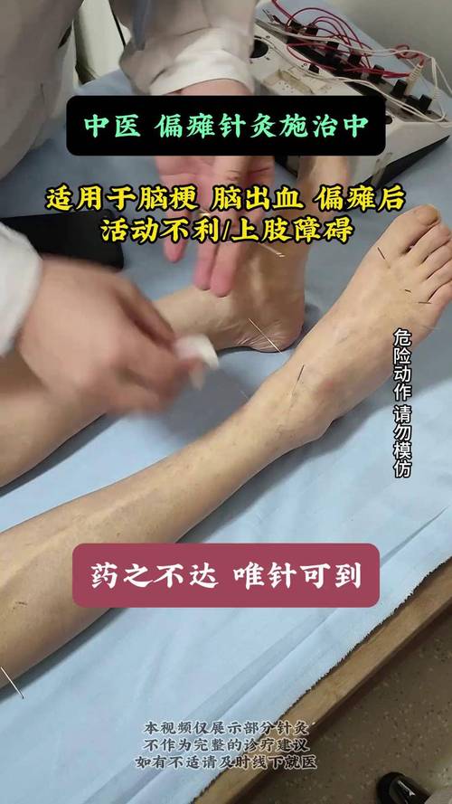 针灸治疗脑瘫的效果