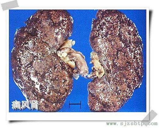 肾结石和痛风有关系吗