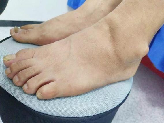 吃了非布司他痛风频繁