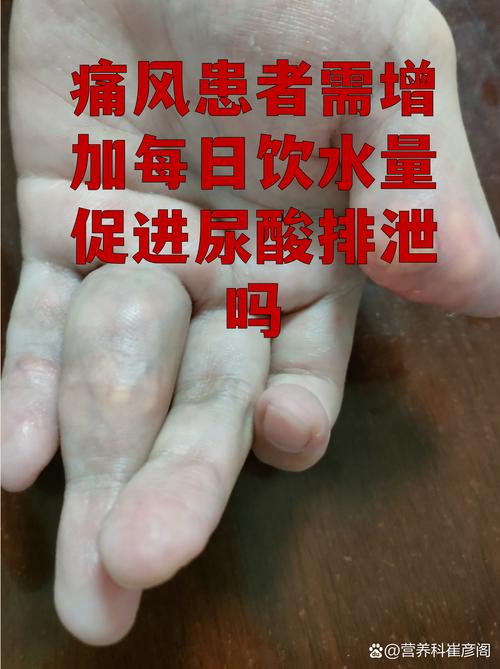 多喝水对痛风有好处吗