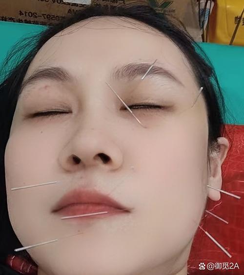 面神经针灸治疗视频