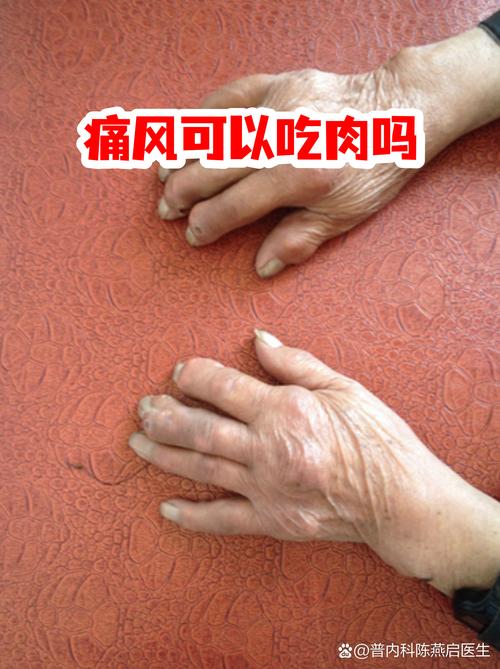 痛风一点肉都不能吃吗