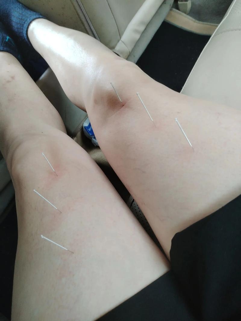 针灸治疗胃动力不足