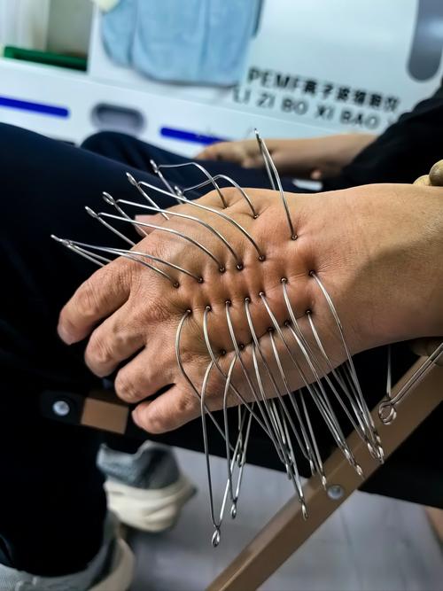 针灸治疗胃动力不足